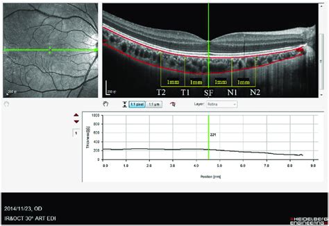 macular choroidal thickness measurement|thickness of choroids.